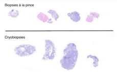 Photos de biopsies effectuées par navigation