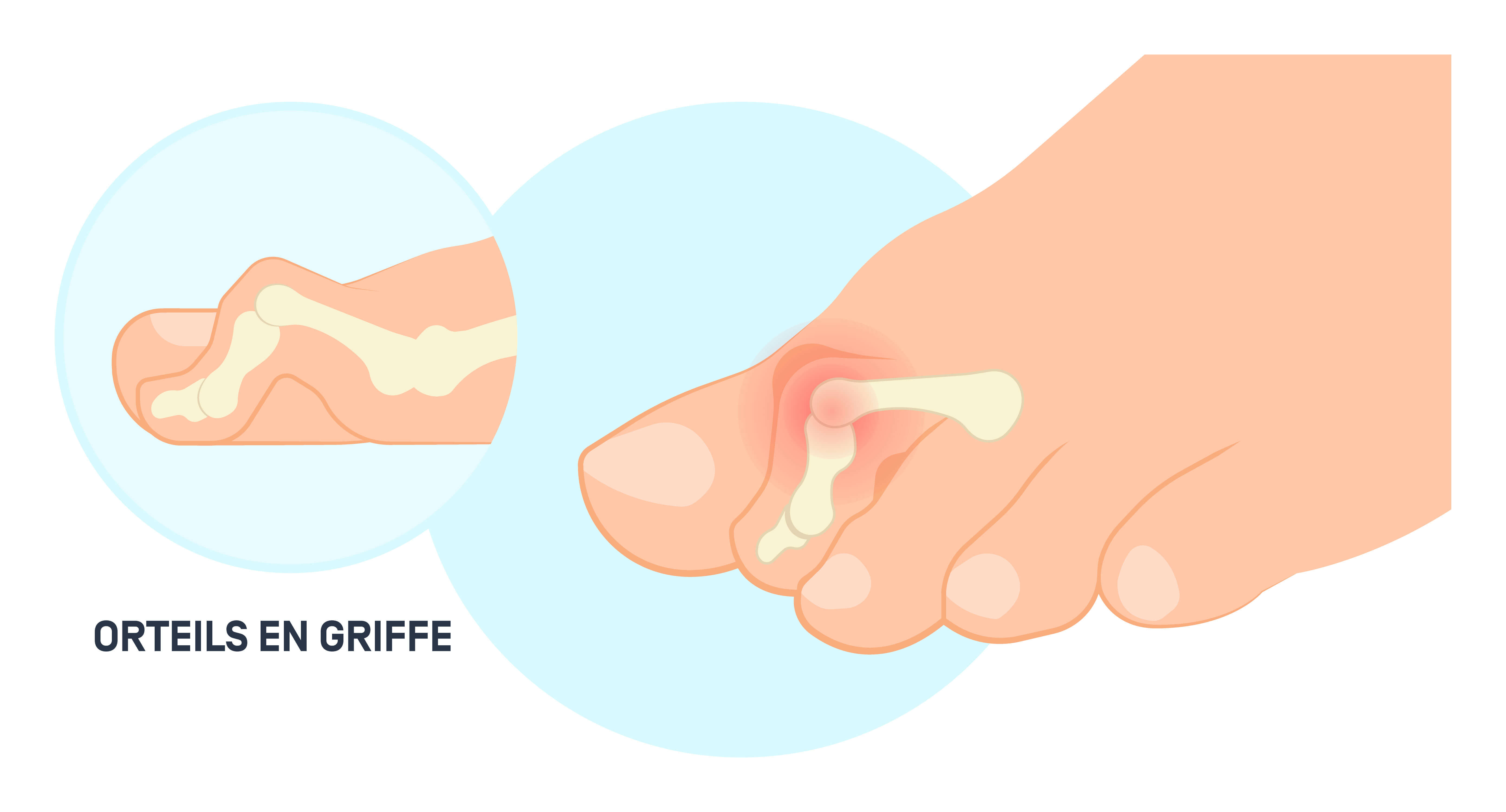 orteils en griffe